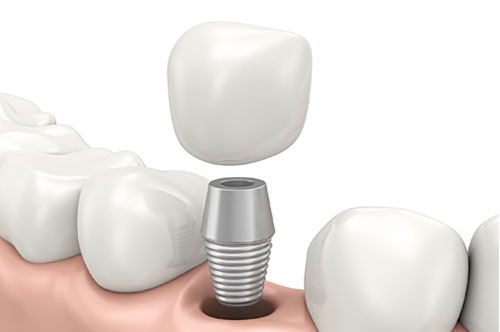 Three Reasons To Get Dental Implants