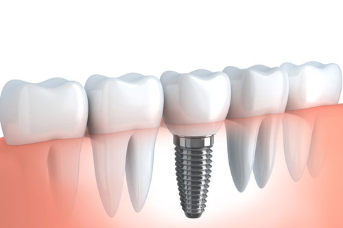 Replace Unhealthy Teeth With Dental Implants!