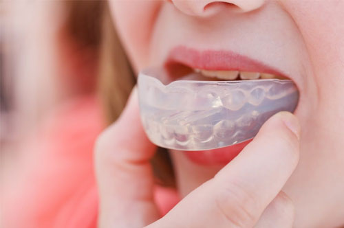 Custom Athletic Mouthguards Protect Your Smile