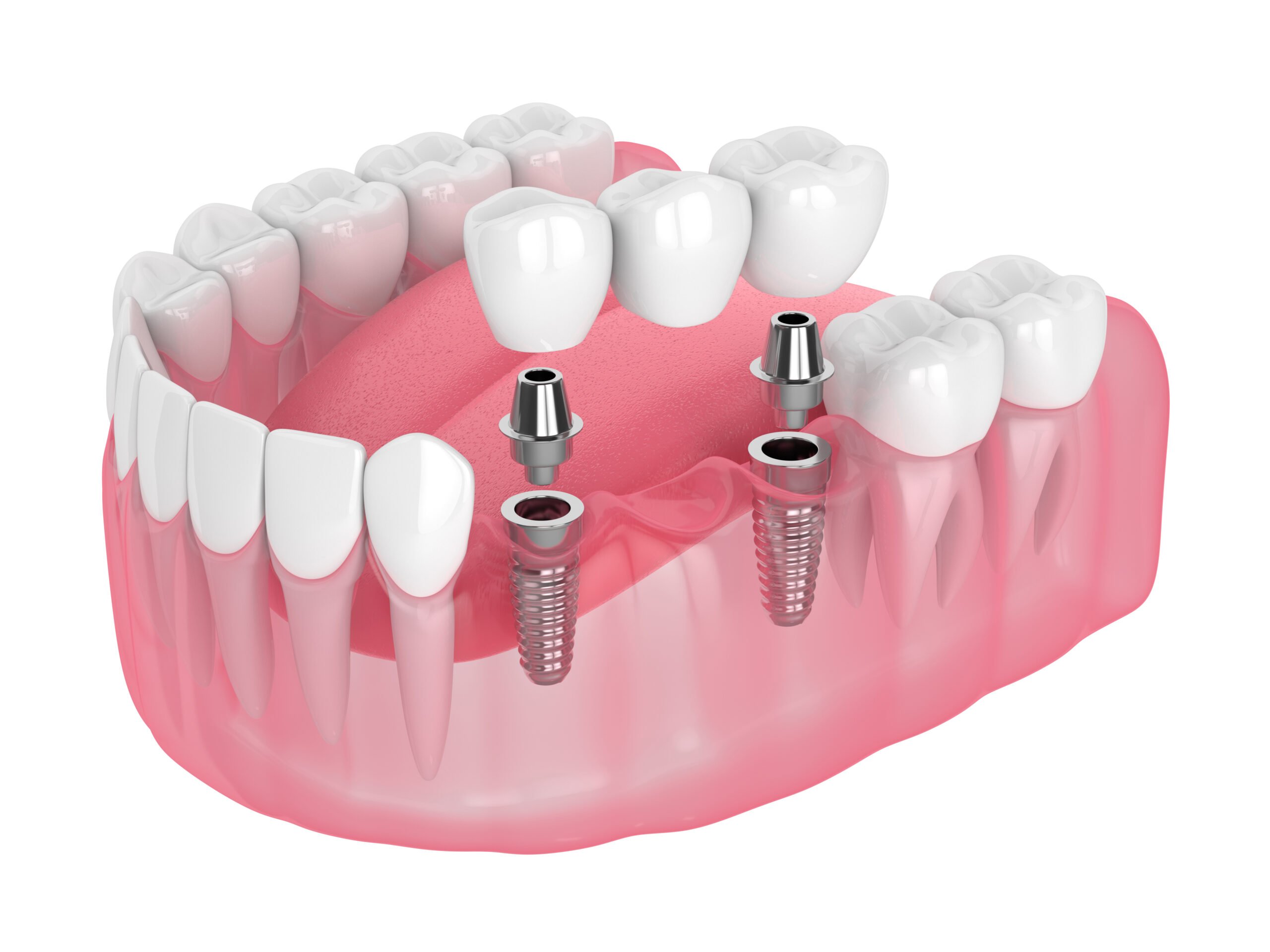 Dental Implants at Fairfield Smiles by Design
