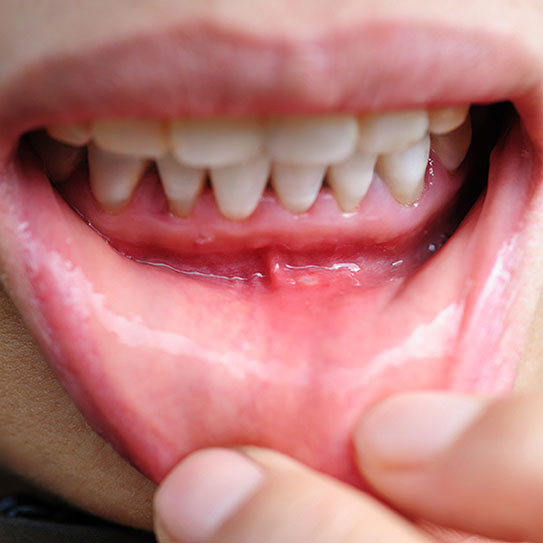 Gum Recession: Causes, Prevention, and Treatment
